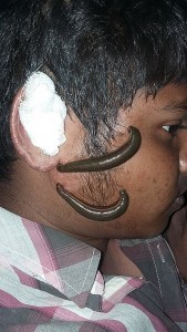 leech_therapy_001