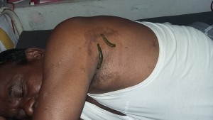 leech_therapy_002